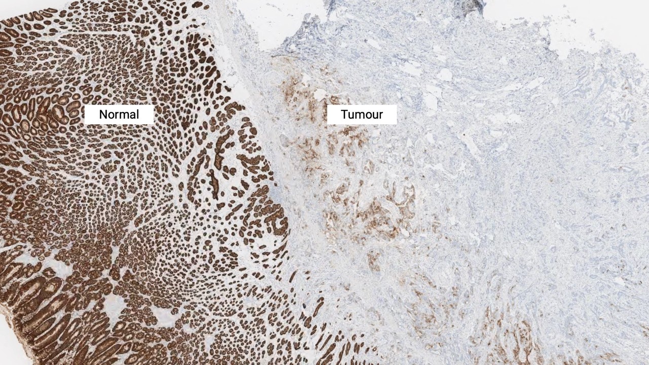 Normal and tumour cell CLDN18.2 staining at 2x magnification